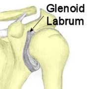 torn labrum shoulder